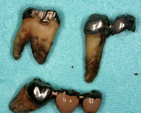 抜けた歯の根には多くの歯石が付いている事が多い。歯肉よりも上の歯石は唾液の由来で白く、逆に歯肉よりも下の歯石は血液由来で黒い歯石が多い。