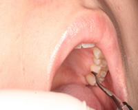 歯石を取る器材を用いて歯石を除去している図歯肉の中を探るので、時には麻酔を行ってする場合があります。