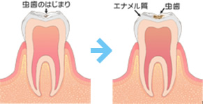 削る必要のないむし歯の場合