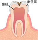 削って詰め物をする必要がある小さなむし歯の場合