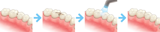 むし歯が小さな範囲の場合