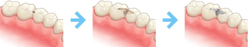 詰め物やかぶせ物を口の外で作る大きなむし歯の場合