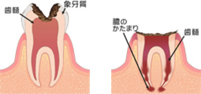 むし歯の範囲が歯の神経まで到達してしまった大きなむし歯の場合