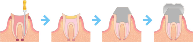 むし歯の範囲が歯の神経まで到達してしまった大きなむし歯の場合