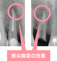 根尖病変の改善