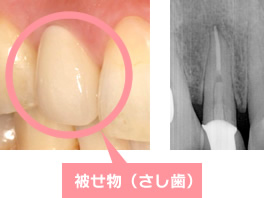 被せ物(さし歯)